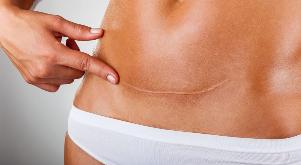 What You Need To Know About Getting Rid Off Of Tummy Tuck?